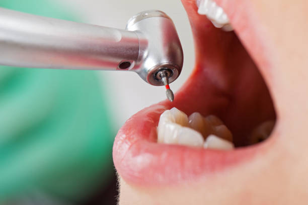 Best Emergency Root Canal Treatment in West Linn, OR